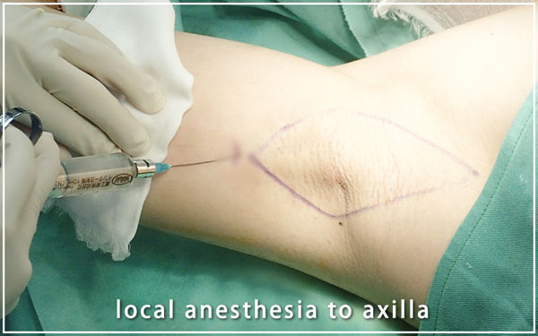 局所麻酔の技術は、手術の仕上がりにも影響2