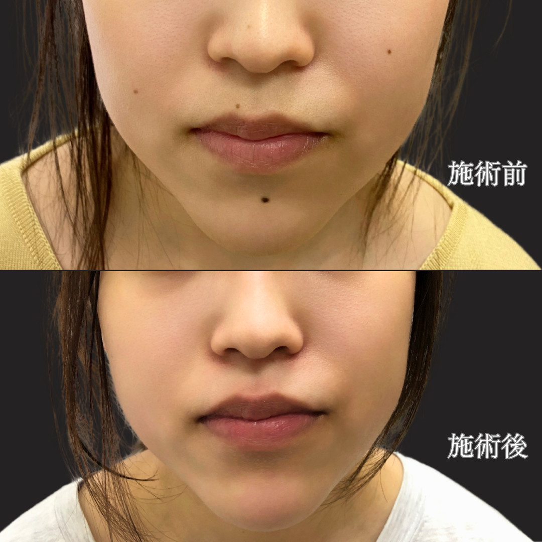 20代女性、メイクでも隠せない黒子を電気メス（モノポーラ）で切除