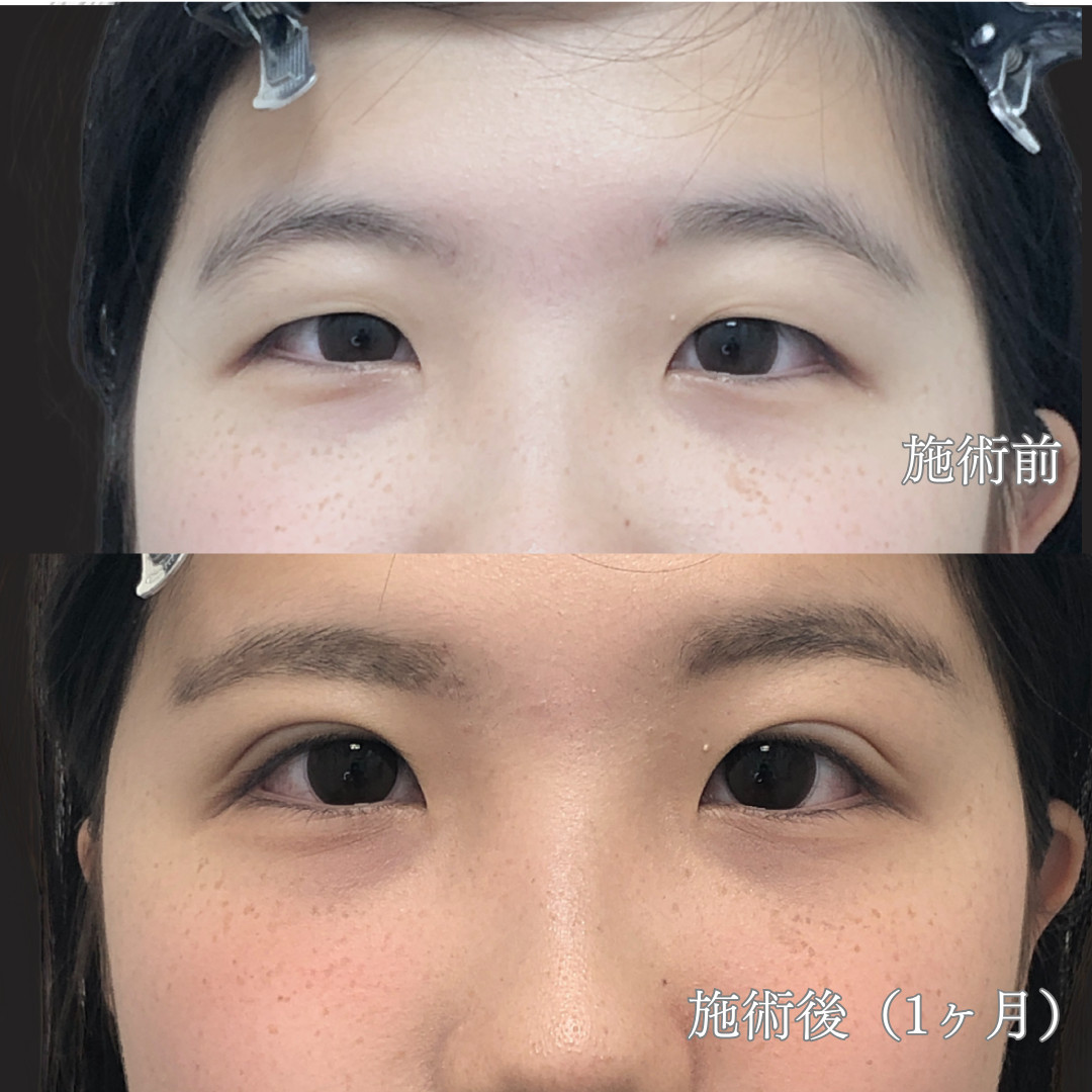 18歳女性｜自然癒着法ダブルモアで末広二重を実現