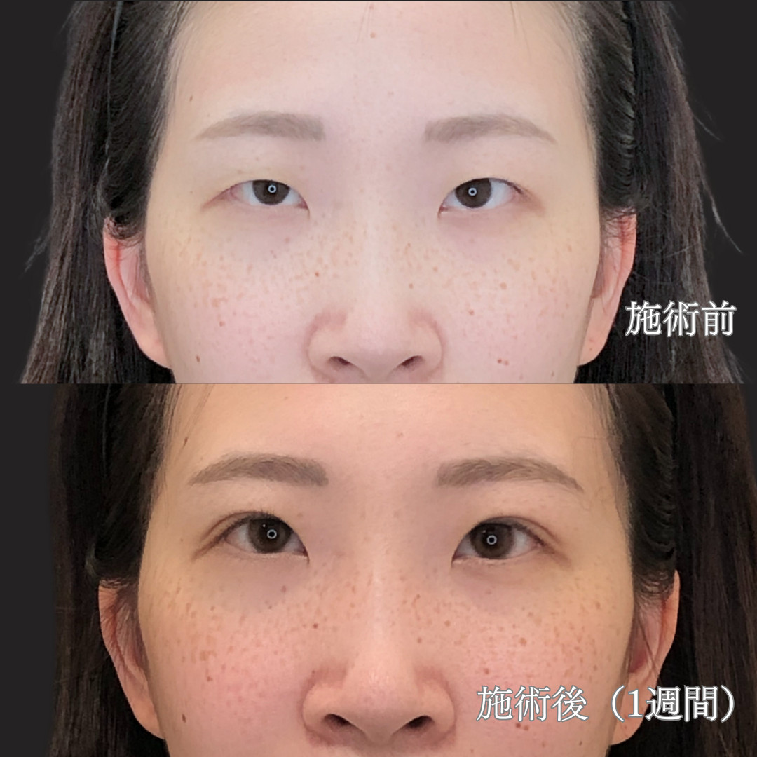 20代女性｜二重埋没P-PL挙筋法GOLDMOREで自然な仕上がり