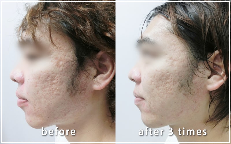 ダーマペン治療経過写真　施術前と3回後の比較