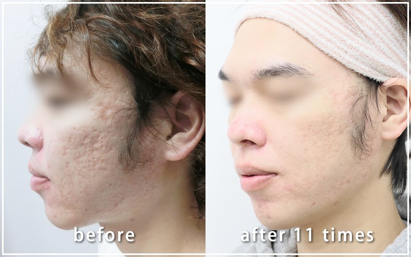 ダーマペン治療経過写真　施術前と11回後の比較