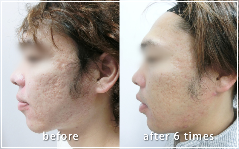 ダーマペン治療経過写真　施術前と6回後の比較
