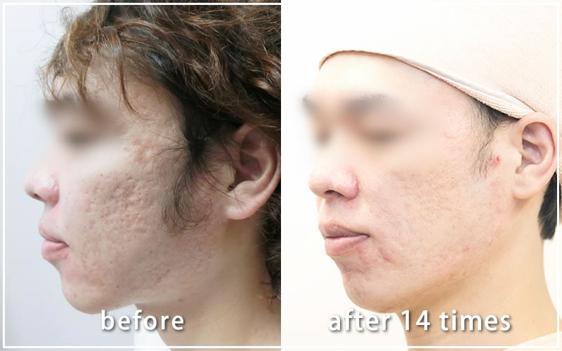 ダーマペン治療経過写真　施術前と14回後の比較