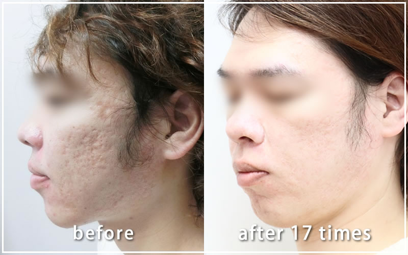 ダーマペン治療経過写真　施術前と17回後の比較