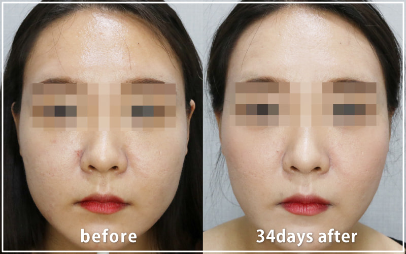 bnlsの症例写真　ケース1