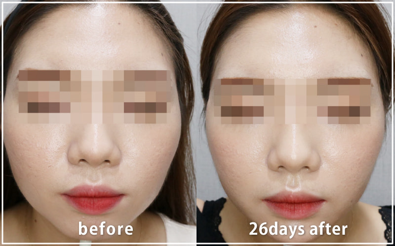 bnlsの症例写真　ケース3