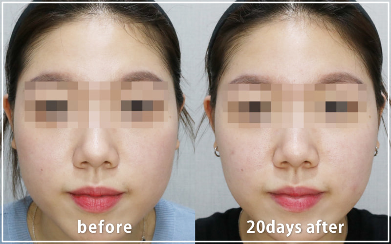 bnlsの症例写真　ケース4　正面