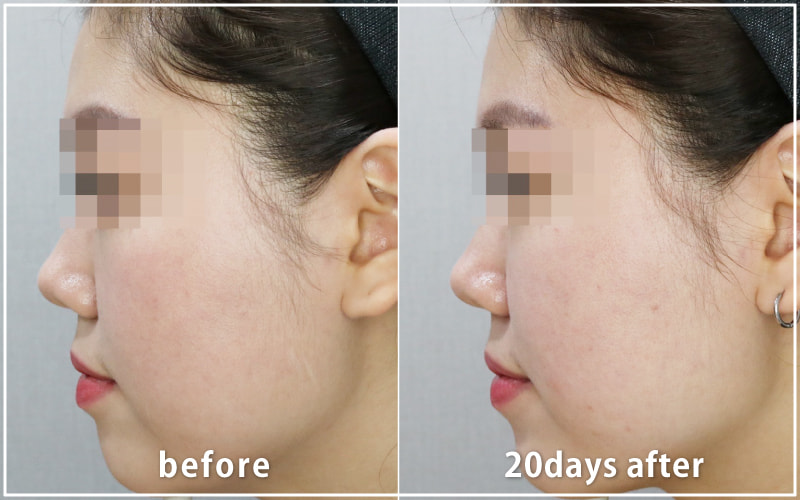 bnlsの症例写真　ケース4　横