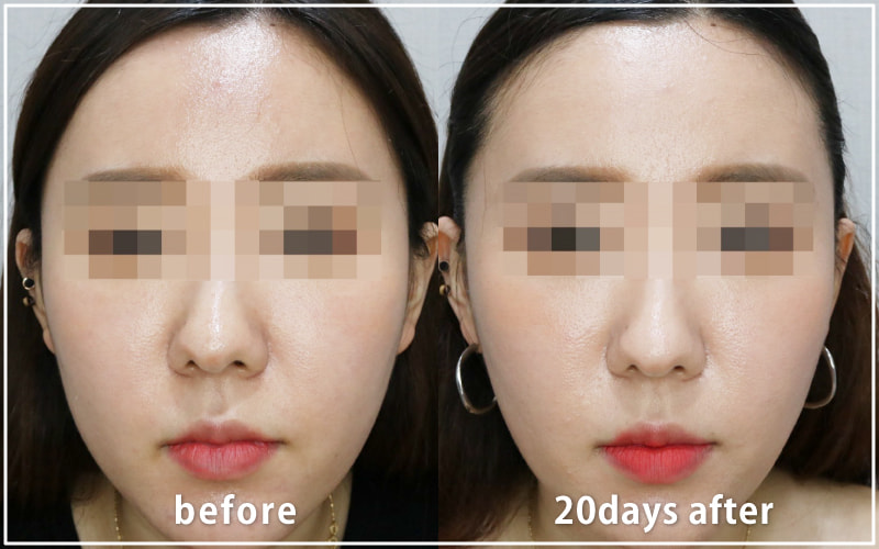 bnlsの症例写真　ケース5