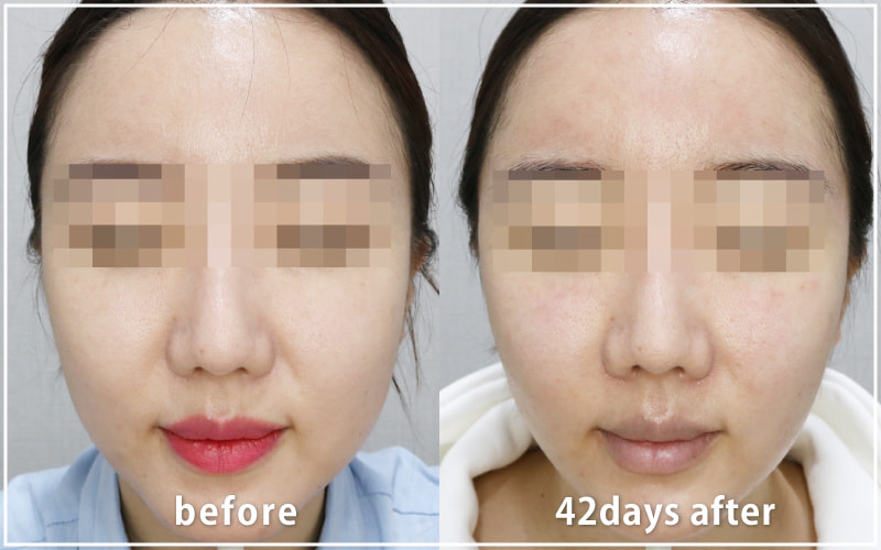 bnlsの症例写真　ケース6　正面