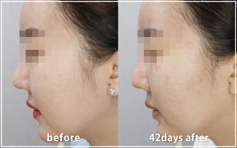 bnlsの症例写真　ケース6　横