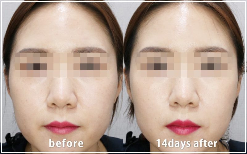 bnlsの症例写真　ケース8