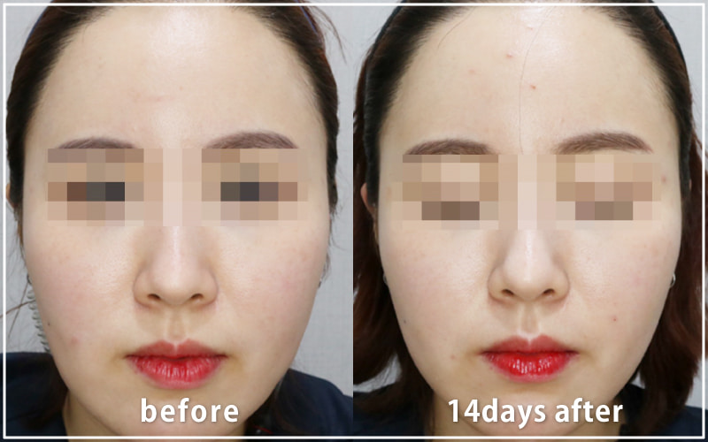 bnlsの症例写真　ケース11　正面