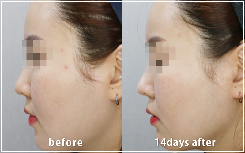 bnlsの症例写真　ケース11　横