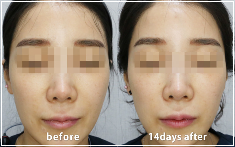 bnlsの症例写真　ケース12　正面