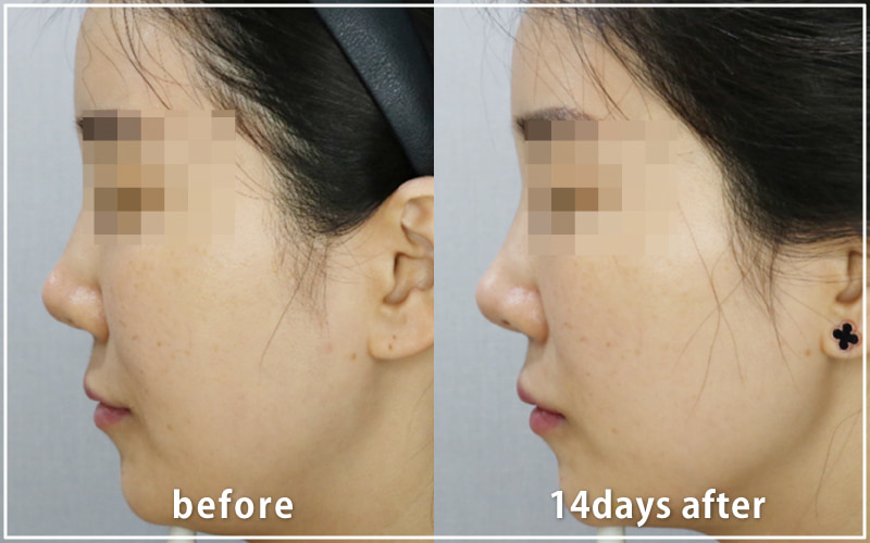 bnlsの症例写真　ケース12　横