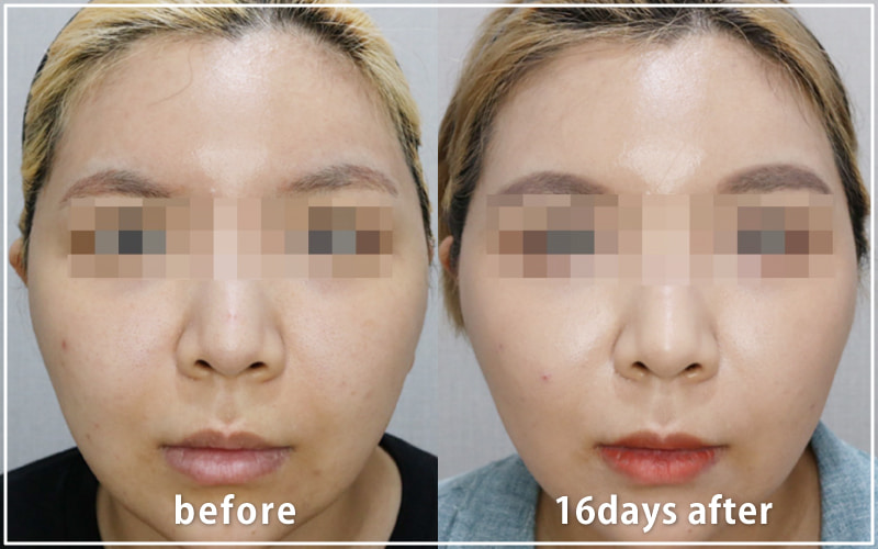 bnlsの症例写真　ケース13　正面