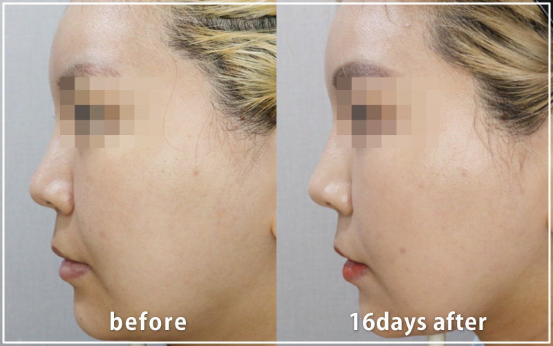 bnlsの症例写真　ケース13　横