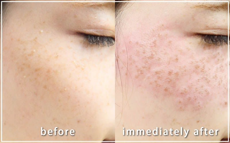 しみ取りレーザーの症例　右側 直後