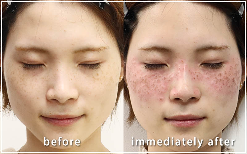 しみ取りレーザーの症例　正面 直後