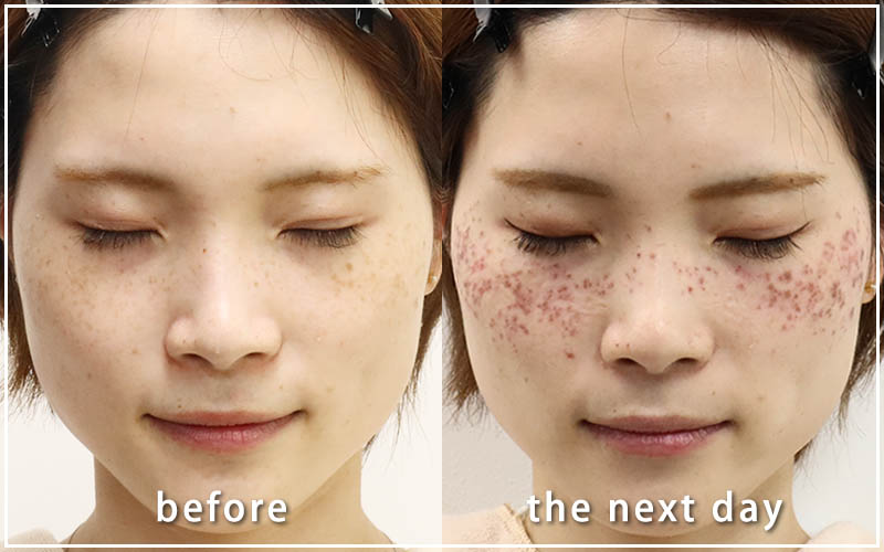 しみ取りレーザーの症例　正面 翌日